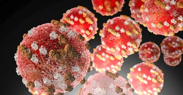 Measles